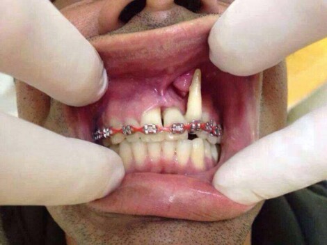 manubay dental diy braces